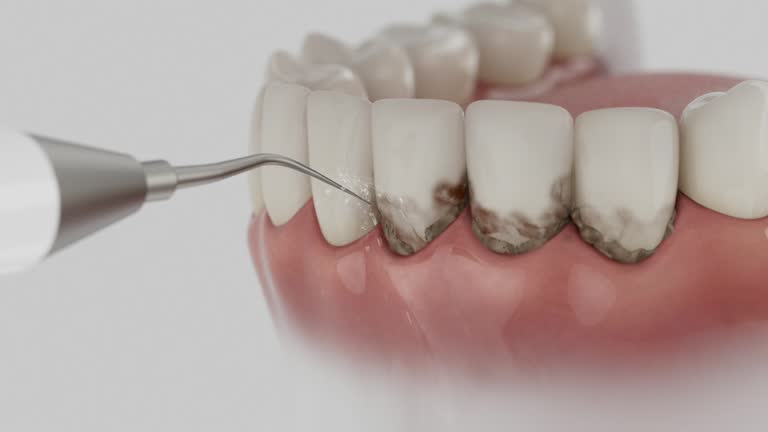 Trusted Wisdom Tooth Removal service in Vacaville, CA - Dentist Open Now